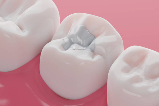 Wisdom Teeth Removal Adelaide Guidelines During Pregnancy from Local Dentists