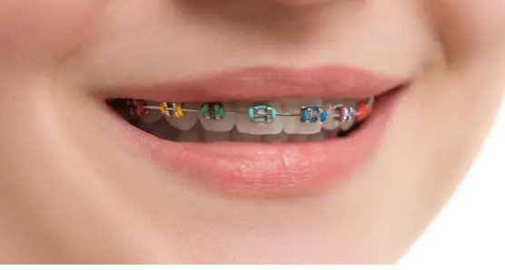 dental braces Adelaide